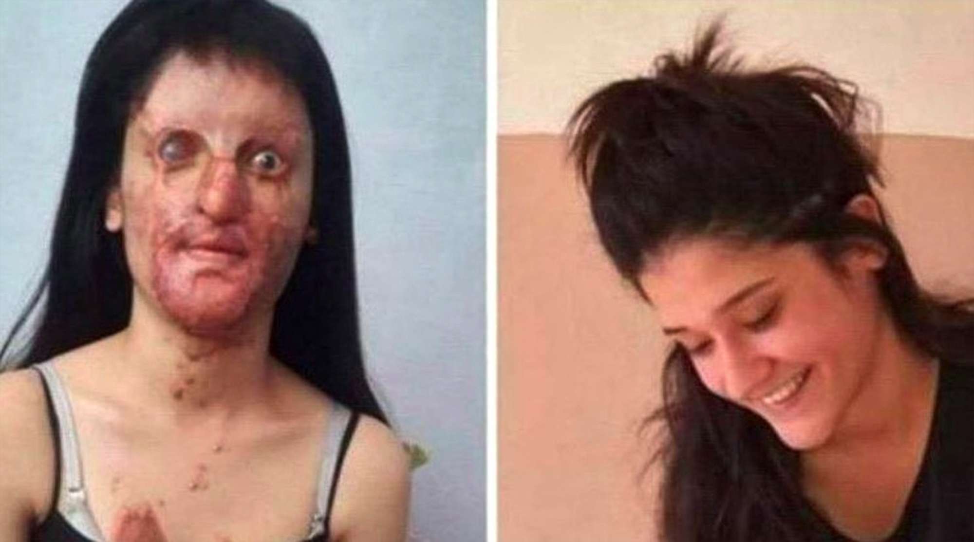 Acid Attacker Jailed As Disfigured Victim Explains Reasons She First Forgave Him